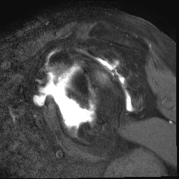 Locked anterior MRI 2